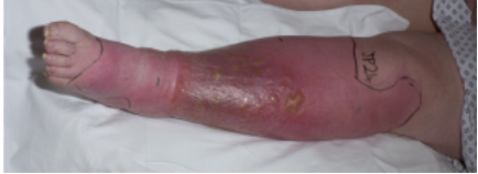 Cellulitis Erysipelas