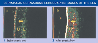 Blood and lymphatic vessels before and after Vibro-Pulse