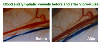 Blood and lymphatic vessels before and after Vibro-Pulse