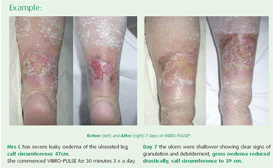 Example of Vibro-Tone treatment of oedema
